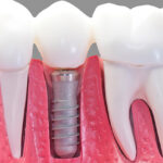 Crowns Bridges Implants at Smile Place Dental