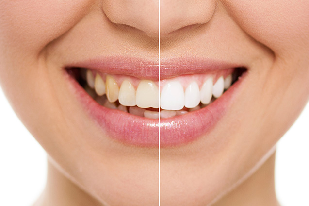 Teeth Whitening at Smile Place Dental