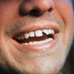 Dental Chips, Scratches Repair at Smile Place Dental