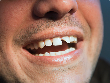 What To Do If You Crack Chip Or Break A Tooth - Radiance Dental