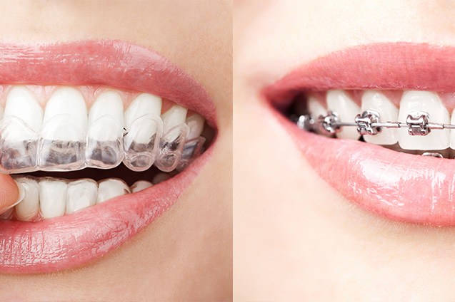 Can I Play Sports While Wearing Braces? - Blue Ridge Orthodontics